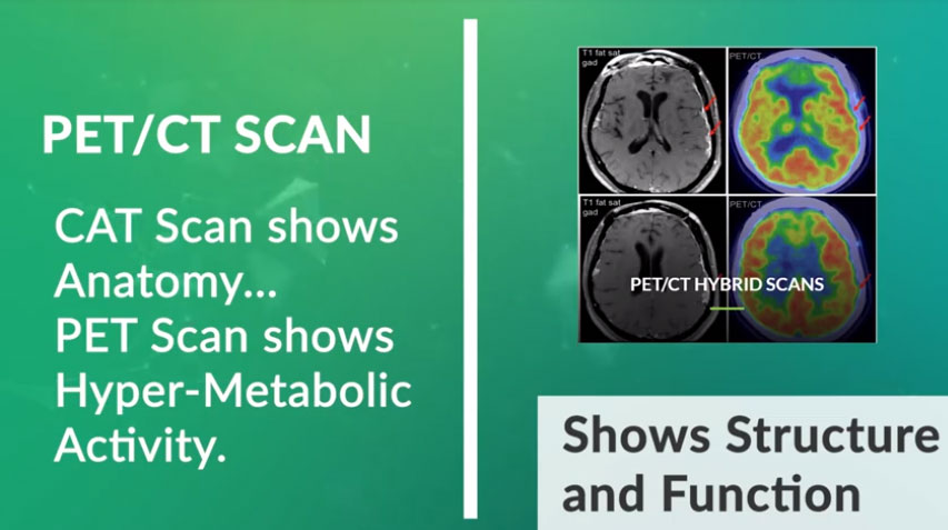 MRI, Why would someone need a PET Scan